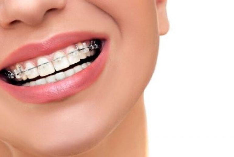 puede la ortodoncia cambiar la forma de tu rostro